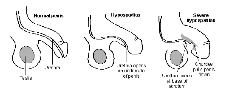 hypospadias-in-infants
