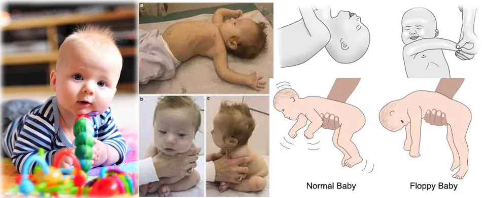 hypotonia-in-infants-floppy-muscle-syndrome