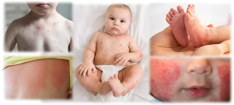 viral-rash-in-infants-does-my-baby-have-a-rash-due-to-a-virus